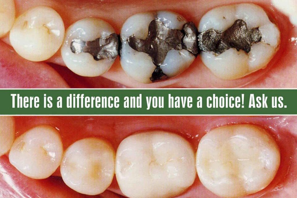 Dental Fillings Composite And Amalgam Explained Dental Fillings Composite And Amalgam Explained