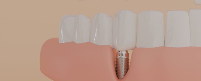 image of a dental Implant in gum, 3D model