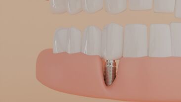 image of a dental Implant in gum, 3D model